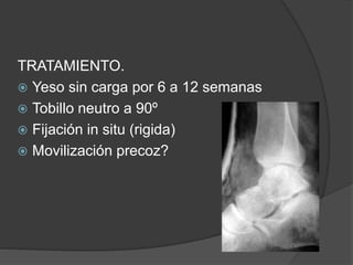 TRATAMIENTO.
 Yeso sin carga por 6 a 12 semanas
 Tobillo neutro a 90º
 Fijación in situ (rigida)
 Movilización precoz?
 
