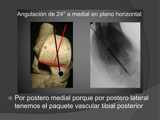  Por postero medial porque por postero lateral
tenemos el paquete vascular tibial posterior
 
