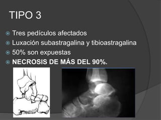 TIPO 3
 Tres pedículos afectados
 Luxación subastragalina y tibioastragalina
 50% son expuestas
 NECROSIS DE MÁS DEL 90%.
 