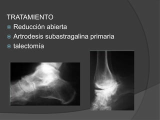 TRATAMIENTO
 Reducción abierta
 Artrodesis subastragalina primaria
 talectomía
 