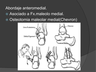 Abordaje anteromedial.
 Asociado a Fx.maleolo medial.
 Osteotomia maleolar medial(Chevron)
 