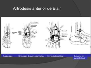Artrodesis anterior de Blair
 