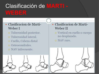 Clasificación de MARTI -
WEBER
 