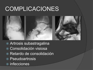 COMPLICACIONES
 Artrosis subastragalina
 Consolidación visiosa
 Retardo de consolidación
 Pseudoartrosis
 infecciones
 