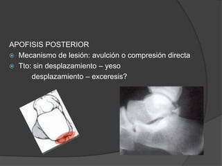 APOFISIS POSTERIOR
 Mecanismo de lesión: avulción o compresión directa
 Tto: sin desplazamiento – yeso
desplazamiento – exceresis?
 