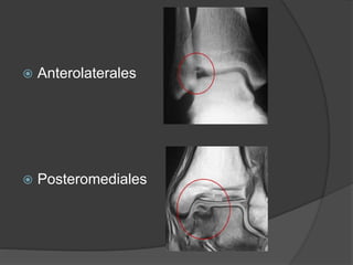  Anterolaterales
 Posteromediales
 
