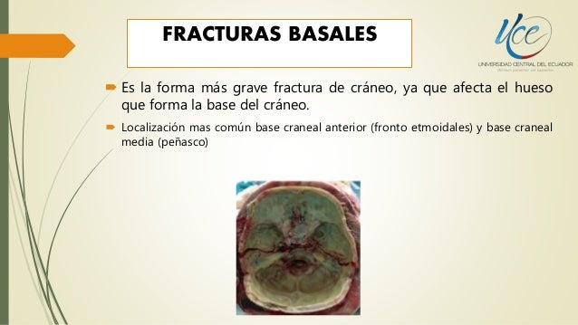 Fractura de base de craneo