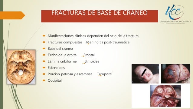 Fractura de base de craneo