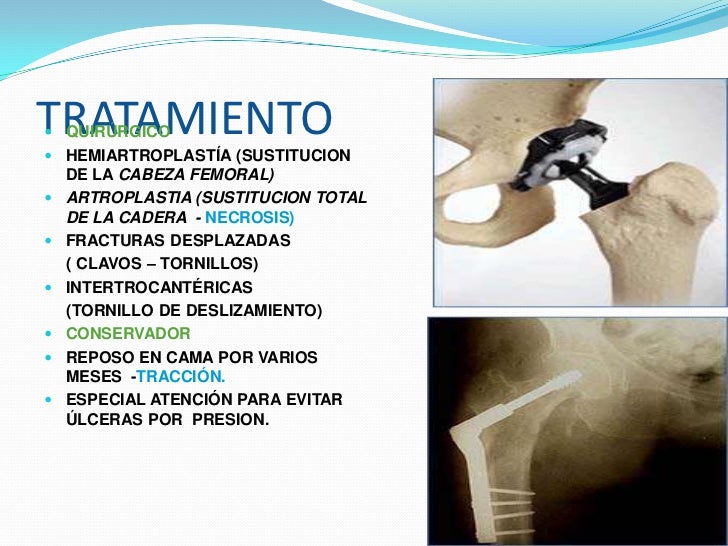 Fractura de cadera Fractura de cadera