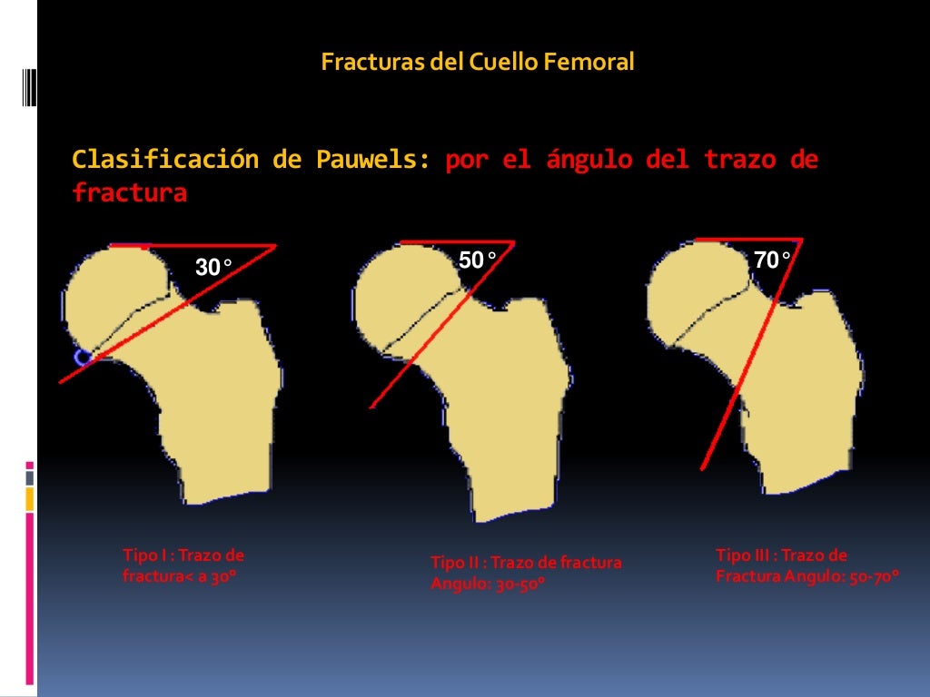 Fractura de cadera