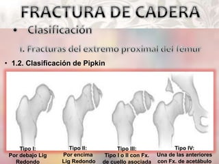 • 1.2. Clasificación de Pipkin
Tipo I:
Por debajo Lig
Redondo
Tipo II:
Por encima
Lig Redondo
Tipo III:
Tipo I o II con Fx.
de cuello asociada
Tipo IV:
Una de las anteriores
con Fx. de acetábulo
 