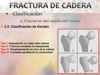 • 2.5. Clasificación de Garden
Tipo I: Impactación en valgo dela cabeza
Tipo II: Fractura completa no desplazada
Tipo III: Desplazamiento en varo de la cabeza
Tipo IV: Completa pérdida de la continuidad
 