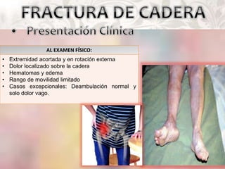 AL EXAMEN FÍSICO:
• Extremidad acortada y en rotación externa
• Dolor localizado sobre la cadera
• Hematomas y edema
• Rango de movilidad limitado
• Casos excepcionales: Deambulación normal y
solo dolor vago.
 