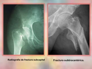 Radiografía de fractura subcapital Fractura subtrocantérica.
 