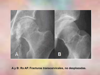 A y B: Rx AP. Fracturas transcervicales, no desplazadas.
 