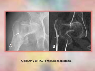 A: Rx AP y B: TAC: Fractura desplazada.
 