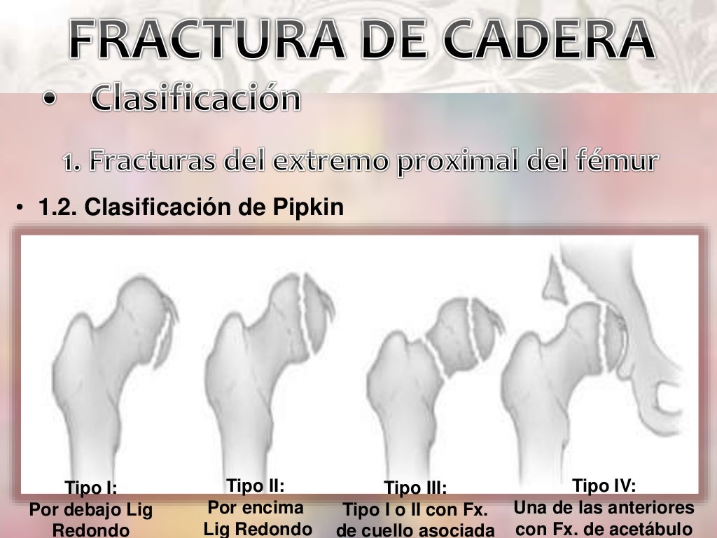 Fractura de Cadera