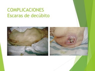 COMPLICACIONES
Escaras de decúbito
 