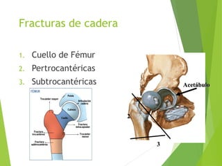 Fracturas de cadera
1. Cuello de Fémur
2. Pertrocantéricas
3. Subtrocantéricas
11
22
33
AcetábuloAcetábulo
 