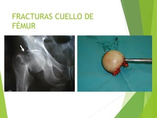 FRACTURAS CUELLO DE
FÉMUR
 