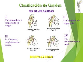 Clasificación de GardenClasificación de Garden
I
Fx Incompleta, o
Impactada en
valgo.
II
Fx Completa, no
desplazada
IIIIII
Fx Completa,
desplazamiento
parcial
IV
Fx.
desplazamiento
total
DESPLAZADASDESPLAZADAS
NO DESPLAZADAS
 