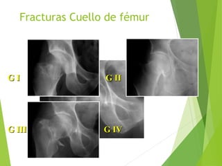 Fracturas Cuello de fémur
G I G IIG I G II
G III G IVG III G IV
 