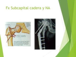 Fx Subcapital cadera y NA
 