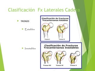 Clasificación Fx Laterales Cadera
 TRONZO
 Estables
 Inestables
 