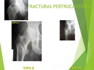 2.-FRACTURAS PERTROCANTÉRICAS
TIPO II TIPO IIITIPO II TIPO III
TIPO ITIPO I
 