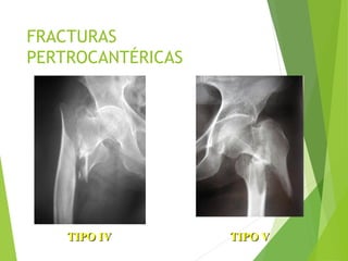 FRACTURAS
PERTROCANTÉRICAS
TIPO IV TIPO VTIPO IV TIPO V
 