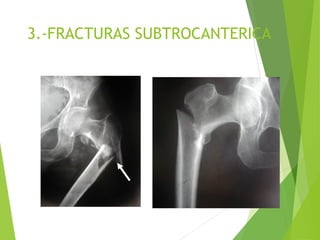3.-FRACTURAS SUBTROCANTERICA
 