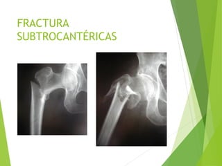 FRACTURA
SUBTROCANTÉRICAS
 