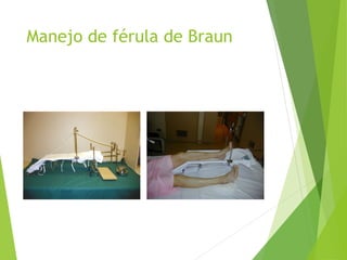 Manejo de férula de Braun
 