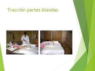 Tracción partes blandas
 