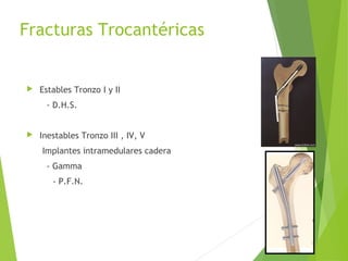 Fracturas Trocantéricas
 Estables Tronzo I y II
- D.H.S.
 Inestables Tronzo III , IV, V
Implantes intramedulares cadera
- Gamma
- P.F.N.
 