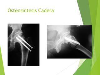 Osteosintesis Cadera
 