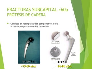 FRACTURAS SUBCAPITAL >60a
PRÓTESIS DE CADERA
 Consiste en reemplazar los componentes de la
articulación por elementos protésicos.
TOTALTOTALPARCIALPARCIAL
>75-80 años 60-80 años>75-80 años 60-80 años
 