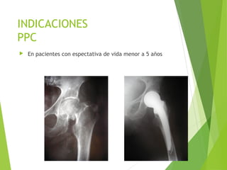 INDICACIONES
PPC
 En pacientes con espectativa de vida menor a 5 años
 