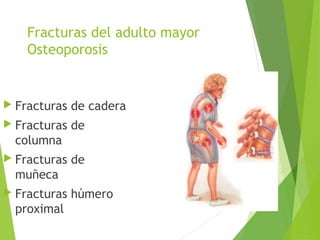 Fracturas del adulto mayor
Osteoporosis
 Fracturas de cadera
 Fracturas de
columna
 Fracturas de
muñeca
 Fracturas húmero
proximal
 