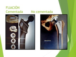 FIJACIÓN
Cementada No cementada
 