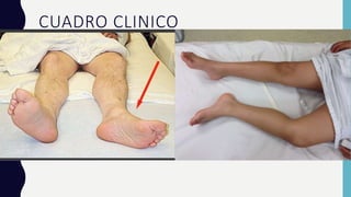 CUADRO CLINICO
• Si la fx es completa hay impotencia funcional para levantarse.
• Además, si se desvían los fragmentos, el miembro inferior: esta rotado hacia fuera (mas
marcado si la fx es extracapsular, por que la intracapsular se sujeta por la capsula)
• Hay acortamiento (por que se sube el trocánter)
• Se próxima a la otra pierna sana (aducción)
• A veces vemos hematomas, equimosis (mas fuerte en al extracapsular, porque si es
intracapsular se queda dentro de la capsula).
• Además hay dolor en zona inguinal
 