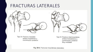 FRACTURAS LATERALES
• Se diferencian según el trazo fracturario, en pertrocantéreas e intertrocantéreas, con
desprendimiento de estos relieves óseos o no, que determinan de alguna manera la estabilidad
o inestabilidad de la fractura.
 