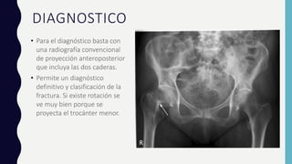 DIAGNOSTICO
• Para el diagnóstico basta con
una radiografía convencional
de proyección anteroposterior
que incluya las dos caderas.
• Permite un diagnóstico
definitivo y clasificación de la
fractura. Si existe rotación se
ve muy bien porque se
proyecta el trocánter menor.
 