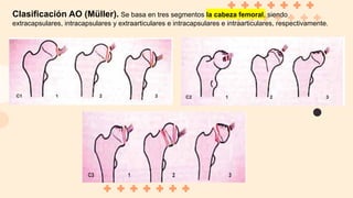 Clasificación AO (Müller). Se basa en tres segmentos la cabeza femoral, siendo
extracapsulares, intracapsulares y extraarticulares e intracapsulares e intraarticulares, respectivamente.
 