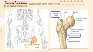 Fracturas Trocantéreas
Es una fractura Extracapsular
Suponen el 50% Son las más frecuentes
 