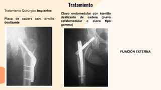 Tratamiento
Tratamiento Quirúrgico Implantes
Placa de cadera con tornillo
deslizante
Clavo endomedular con tornillo
deslizante de cadera (clavo
cefalomedular o clavo tipo
gamma)
FIJACIÓN EXTERNA
 