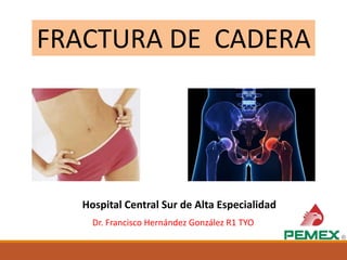 FRACTURA DE CADERA
Hospital Central Sur de Alta Especialidad
Dr. Francisco Hernández González R1 TYO
 