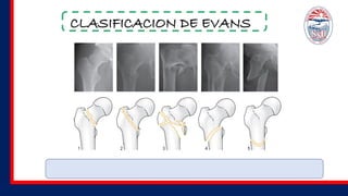 CLASIFICACION DE EVANS
 