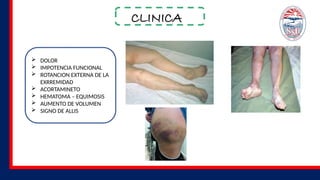 CLINICA
 DOLOR
 IMPOTENCIA FUNCIONAL
 ROTANCION EXTERNA DE LA
EXRREMIDAD
 ACORTAMINETO
 HEMATOMA – EQUIMOSIS
 AUMENTO DE VOLUMEN
 SIGNO DE ALLIS
 
