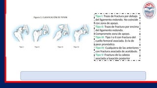Tipo I: Trazo de fractura por debajo
del ligamento redondo. No coincide
con zona de apoyo.
Tipo II: Trazo de fractura por encima
del ligamento redondo.
Compromete zona de apoyo.
Tipo III: Tipo I o II con fractura del
cuello femoral asociada. Es la de
peor pronóstico.
Tipo IV: Cualquiera de las anteriores
con fractura asociada de acetábulo.
Tipo V: Fractura de la cabeza
asociada a luxación posterior
 
